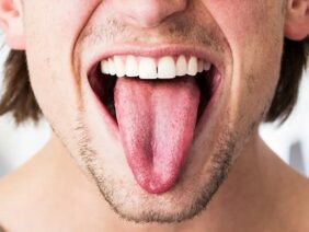 Coconut Oil – Effective treatment for Mouth Thrush (Oral thrush)