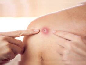 MonkeyPox Virus Early Signs, Symptoms, Prevention and Treatment